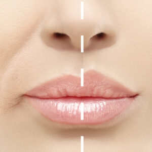 Hyaluron Pen Labios / surco nasogeniano