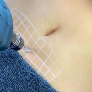 Hyaluron Pen Corporal (zona) – 5 sesiones